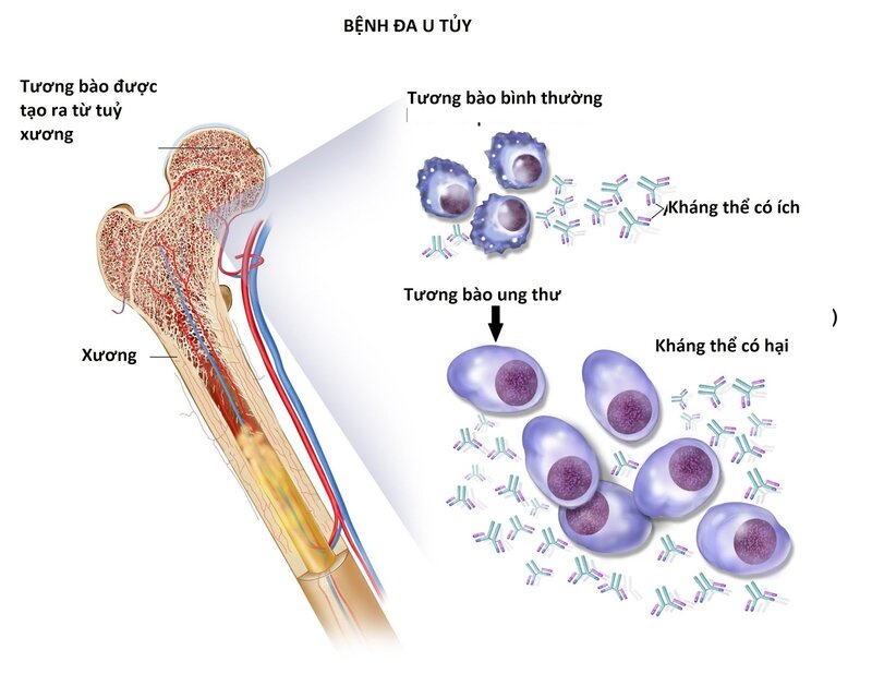 Đa u tủy xương