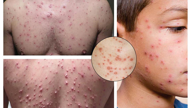 Bệnh thủy đậu (Varicella Zoster)