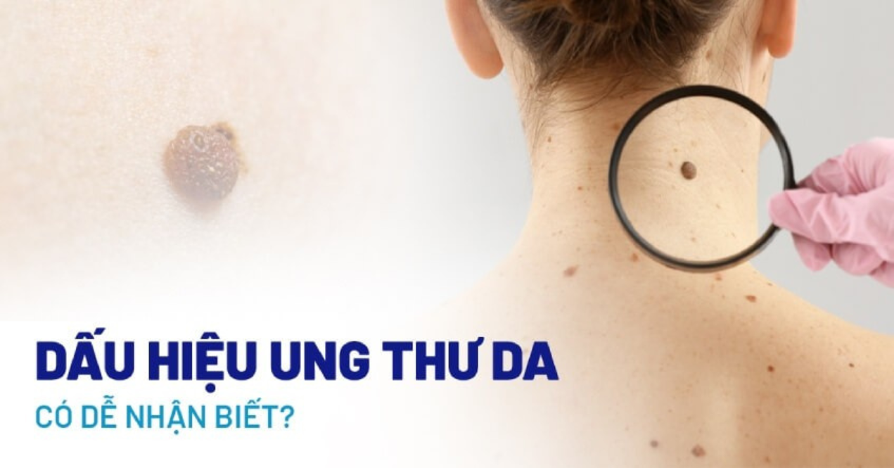 Ung thư da
