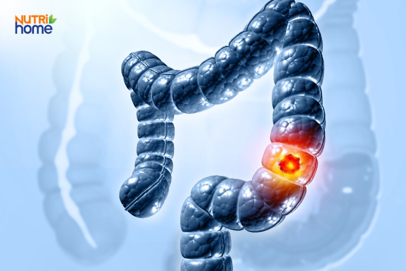 Bệnh viêm ruột (Bệnh Crohn) (IBD)
