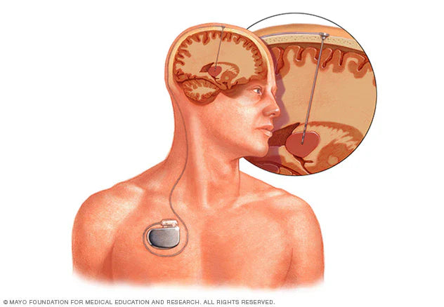 Kích thích não sâu (Deep Brain Stimulation – DBS)