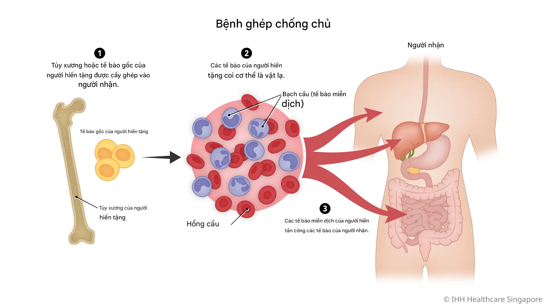 Bệnh Mảnh Ghép Chống Lại Vật Chủ (GvHD)