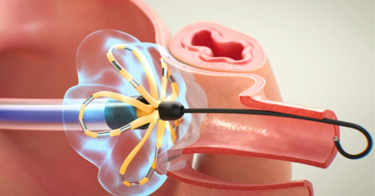 Triệt Đốt Catheter Điều Trị Rung Nhĩ (AFib)