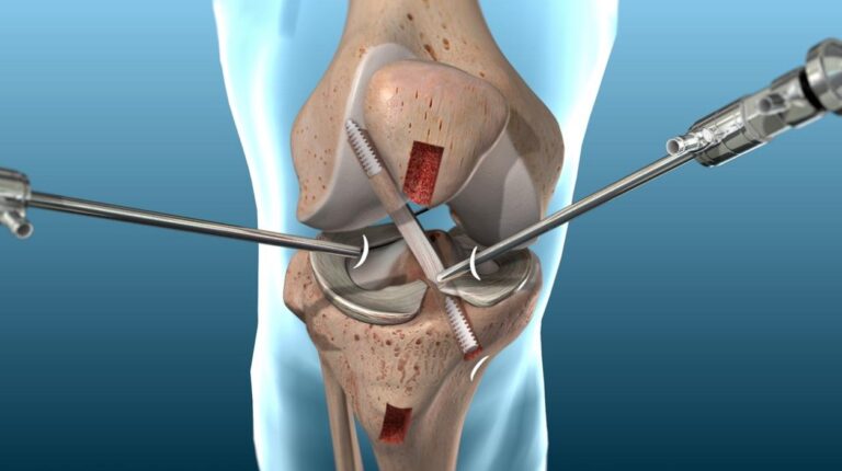 Phẫu thuật tái tạo dây chằng chéo trước (ACL Reconstruction) là gì?