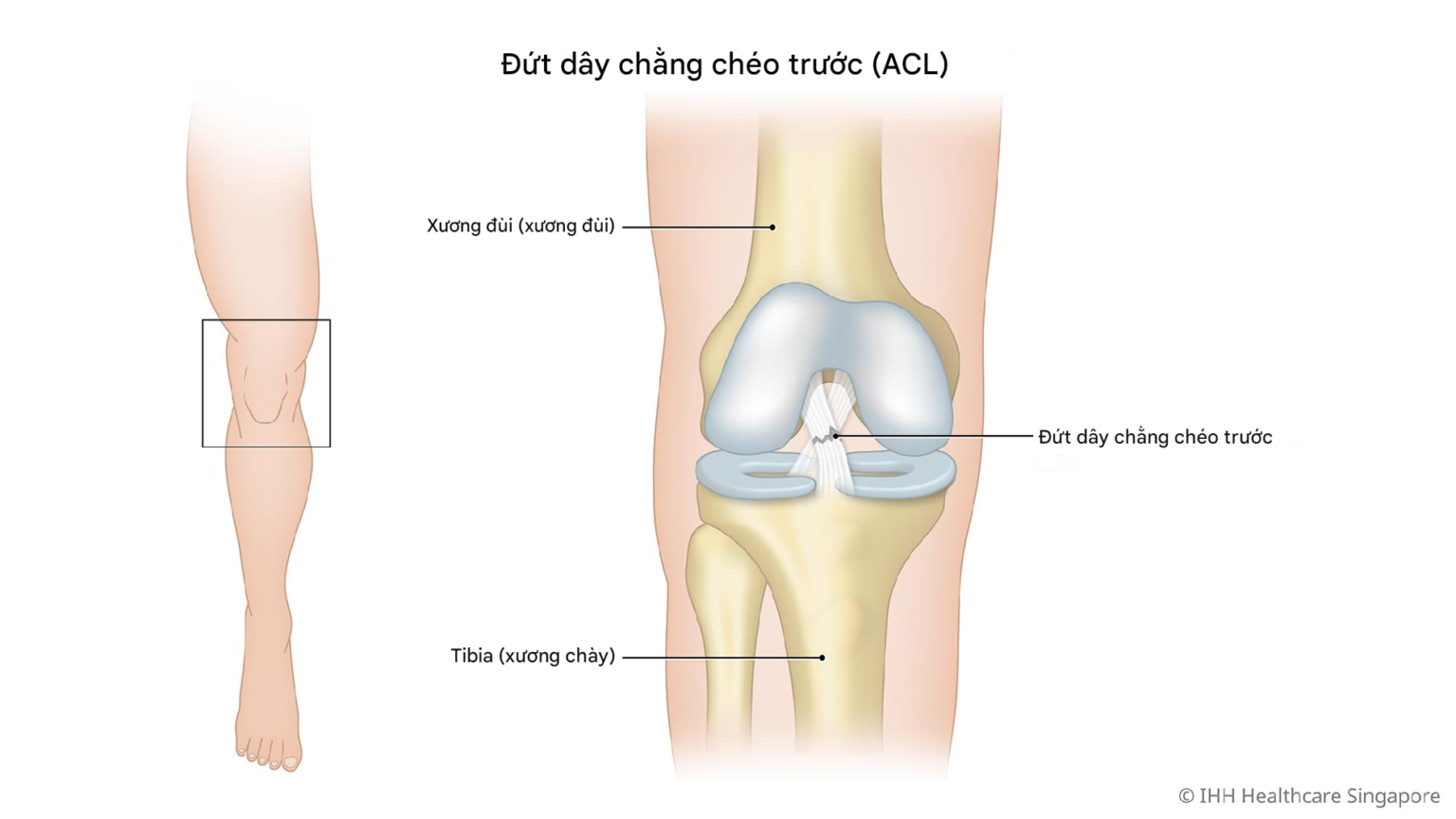 Rách dây chằng chéo trước đầu gối (ACL)