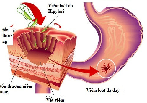 Loét dạ dày-tá tràng